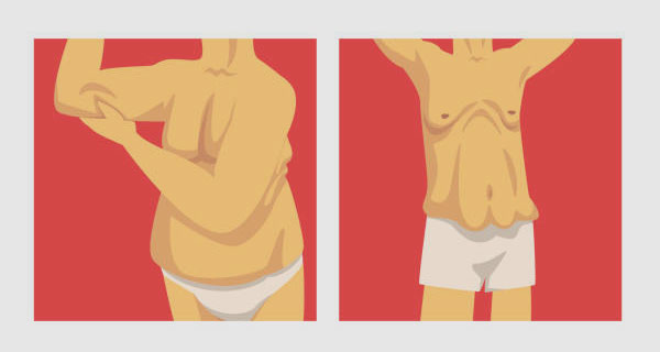 The Benefits and Effects of Post-Bariatric Surgery