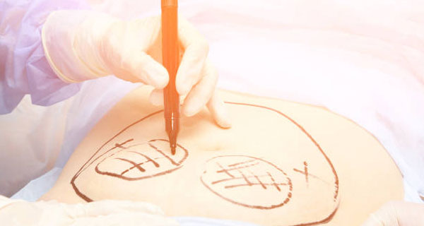 Lipödem Tedavisinde Kombine Yaklaşım: Liposuction ve Germe Ameliyatları